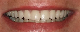 CEREC AC OMNICAM ПРОСТОЕ СКАНИРОВАНИЕ БЕЗ АНТИБЛИКОВОГО СПРЕЯ 27.jpg